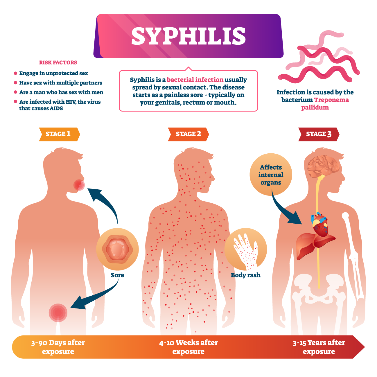 The Stages of Syphilis